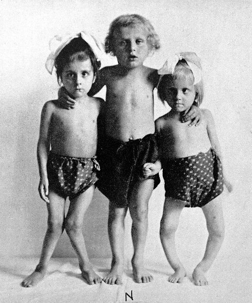 VitaminDMangel bei Kindern Rachitis? LCHF Deutschland